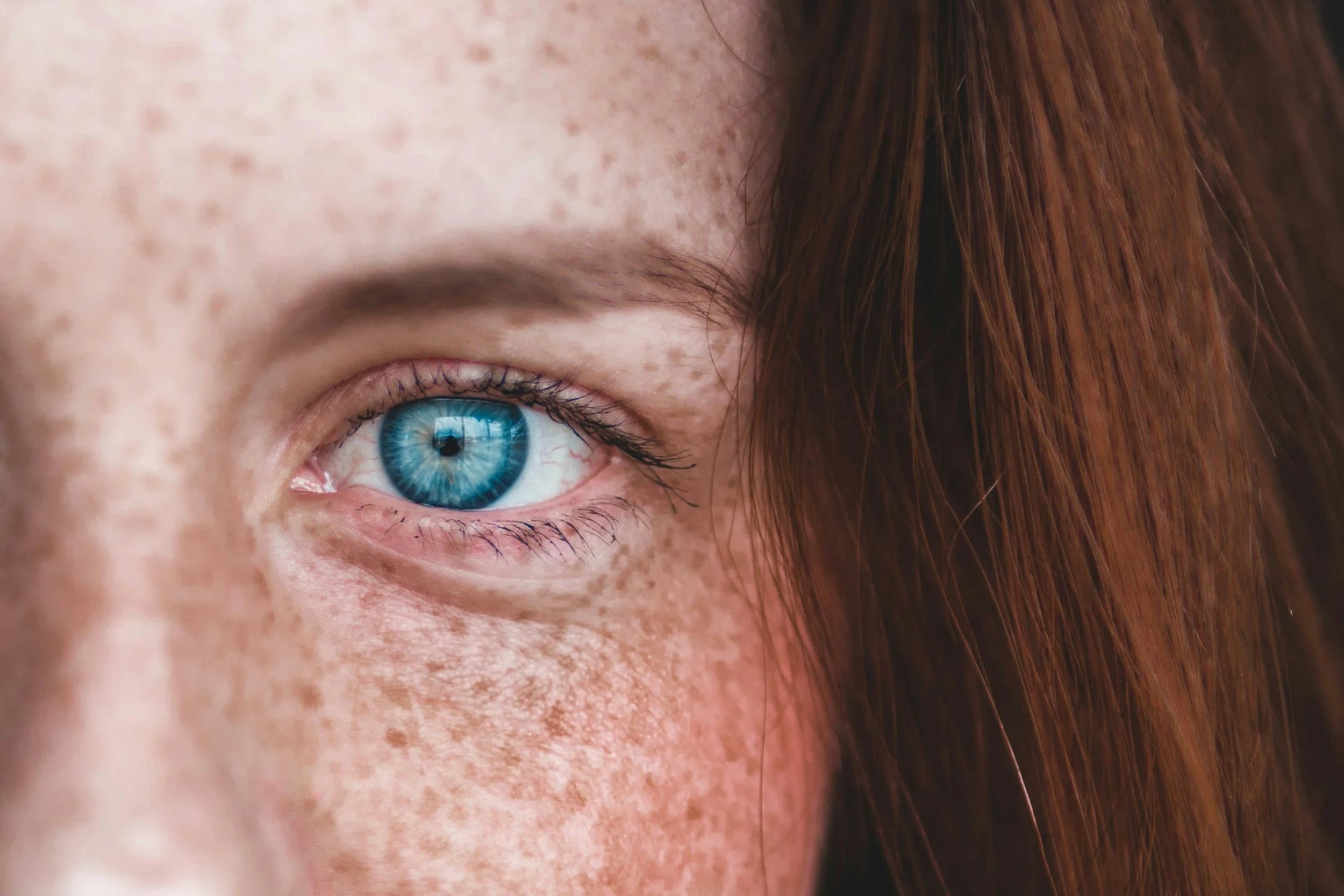 Comprendre le lentigo : Causes, symptômes et traitements