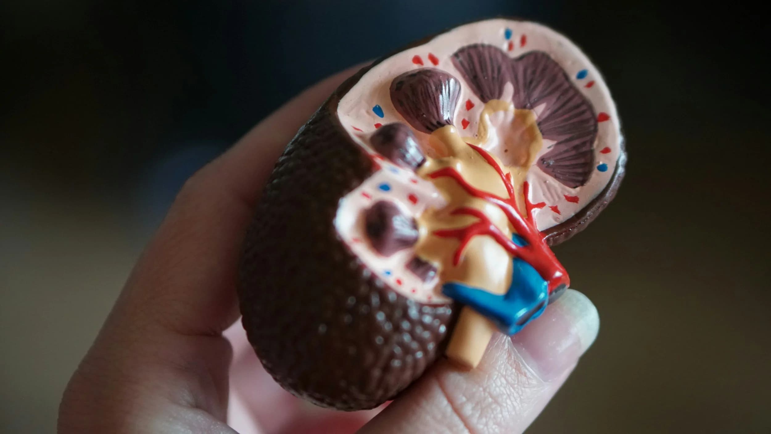 Renal Colic: Understanding, Preventing, and Treating
